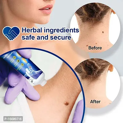 Warts Remover Ointment Wart Treatment Cream Skin Tag Remover Herbal Extract Warts Remover Ointment-thumb3