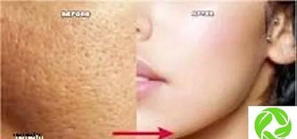 Open Pores Gel Based Cream-thumb1