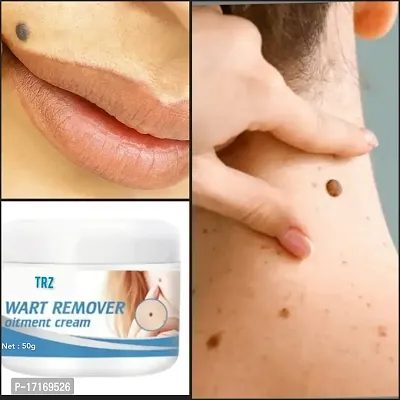 Warts Remover  Cream For Scar Removal, Anti-acne  Pimples, Marks  Spots Removal-thumb0