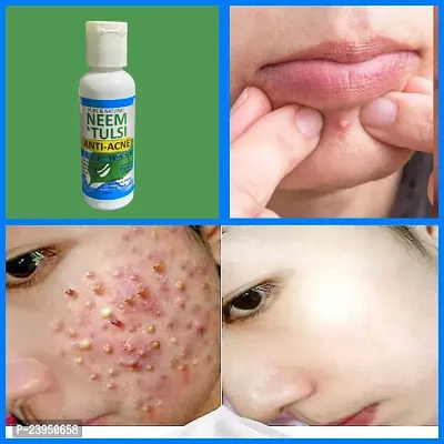 Bye Bye Pimple NeemTulsi Face Wash For Pore Tightening  REMOVE Acne,  Blackheads, face Anti Ageing AND Whitening 50ml