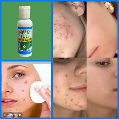 Bye Bye Pimple NeemTulsi Face Wash For Pore Tightening  REMOVE Acne,  Blackheads, face Anti Ageing AND Whitening 50ml-thumb4