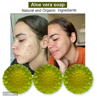 Aloe Vera Soap For Acne-Prone Skin-100 Grams Each, Pack Of 3