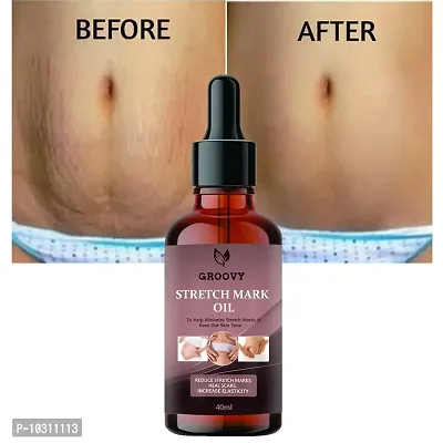 Stretch Marks Oil Present Repair Stretch Marks Removal Cream - Natural Heal Pregnancy Breast, Hip, Legs, Mark Oil 40 Ml-thumb0