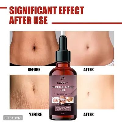 Stretch Marks Oil Organics Stretch Mark Removal Oil Men Under Arms Stretch Mark Bio Oil And Scars Removal 40 Ml-thumb0