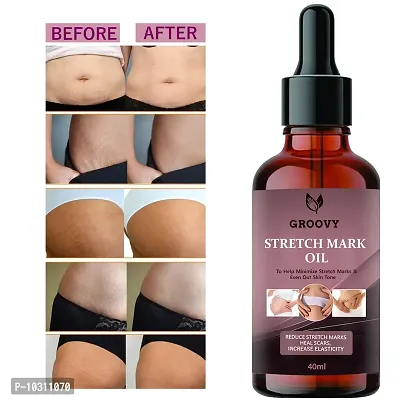 Stretch Mark Cream To Reduce Stretch Marks And Scars-40 Ml-thumb0