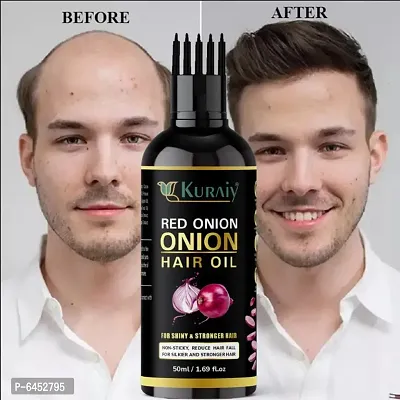 Onion Hair Oil For Hair Growth And Hair Fall Control ,Non Sticky Hair Oil For Stronger ,Thiker and Glossier hair For men and women-thumb0