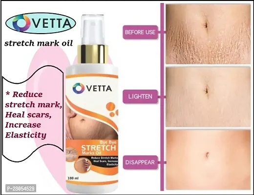 Ovetta Stretch mark removal oil men and women 100 ml (PACK OF-1)