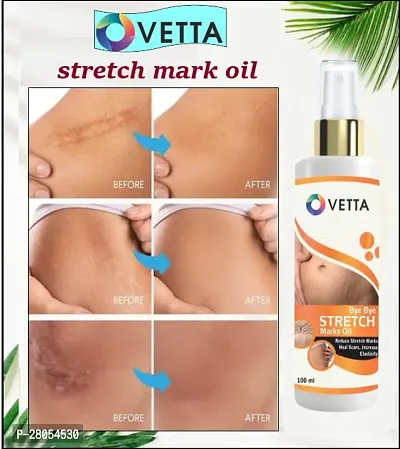 Ovetta Stretch mark removal oil men and women 100 ml (PACK OF-1)