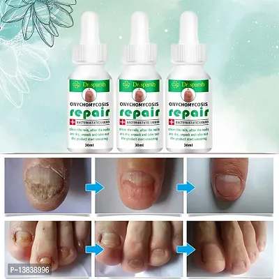 DR.SPARSH NAIL SERUM FOR NAIL GROWTH  REPAIR, FUNGAL INFECTION, ANTI-INFECTIVE REMOVAL PARONYCHIA ONYCHOMYCOSIS |30ML(PACK OF 3PCS)