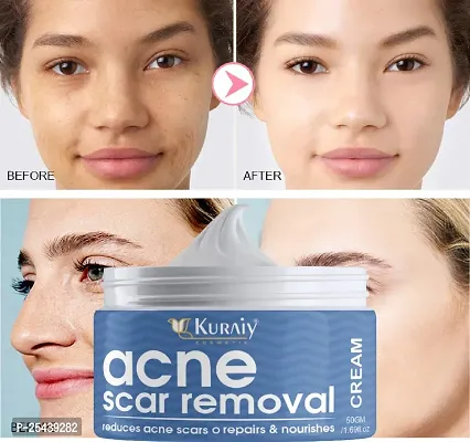 KURAIY Natural Scar And Mark Removal Gel Ointment Acne Scar Cream Repair Stretch Mark Ointment Gel Anti Acne Treatment Cream