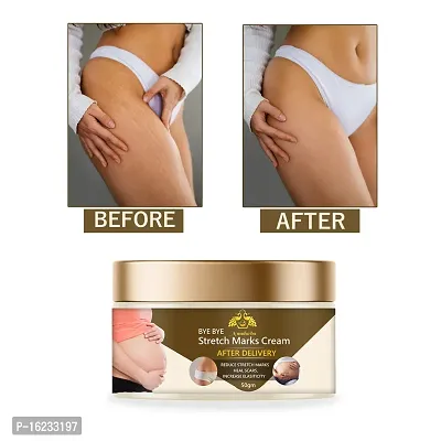 Nandurba after delivery stretch mark removal cream