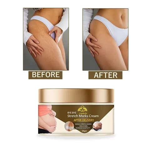 Stretch Marks Cream To Reduce Stretch Marks And Scars (Pack Of 1)