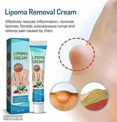 Chiwa Lipoma Removal Cream Lipoma Removal Cream Ointment Lipoma Elimination Cream for Lipoma Treatment Cellulite Removal Cream, Anti-Swelling Lymphatic Ointment (pack of 3)-thumb2