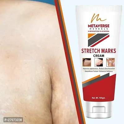 Stretch Mark cream for pregnancy | Stretch Mark lotion | Stretch mark therapy cream | Stretch Mark Creams | Stretch Mark Removal Cream-thumb0