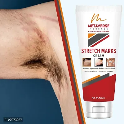 Postpartum Stretch Mark Cream | Stretch Mark Prevention Oil | Stretch Mark Cream for Men | Anti-Stretch Mark Body Butter | Stretch Mark Treatment |-thumb0