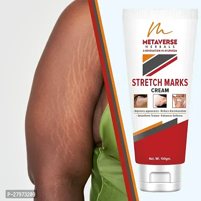 Best stretch mark cream | Pregnancy stretch mark removal | Stretch mark prevention cream | Stretch mark treatment | Natural stretch mark cream.-thumb0