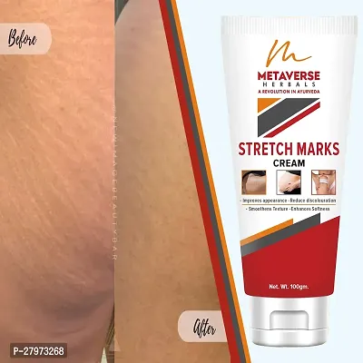 Best stretch mark cream | Pregnancy stretch mark removal | Stretch mark prevention cream | Stretch mark treatment | Natural stretch mark cream.-thumb0