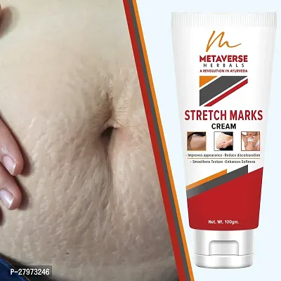 Postpartum Stretch Mark Cream | Stretch Mark Prevention Oil | Stretch Mark Cream for Men | Anti-Stretch Mark Body Butter | Stretch Mark Treatment |-thumb0