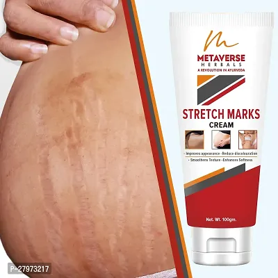 Stretch mark oil | Post-pregnancy stretch mark cream | Effective stretch mark reduction |Stretch mark cream for sensitive skin |Organic stretch mark solution.-thumb0