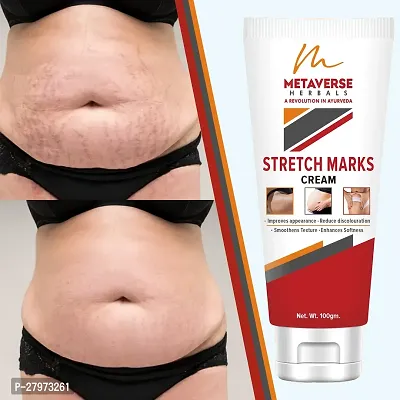 Best stretch mark cream | Pregnancy stretch mark removal | Stretch mark prevention cream | Stretch mark treatment | Natural stretch mark cream.-thumb0