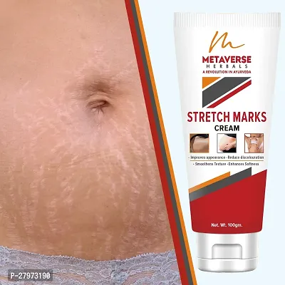 Best stretch mark cream | Pregnancy stretch mark removal | Stretch mark prevention cream | Stretch mark treatment | Natural stretch mark cream.-thumb0