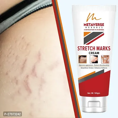 Best stretch mark cream | Pregnancy stretch mark removal | Stretch mark prevention cream | Stretch mark treatment | Natural stretch mark cream.-thumb0