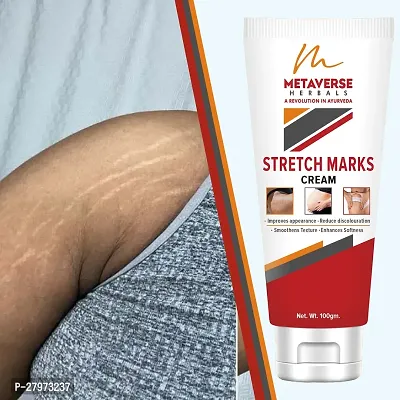 Stretch mark oil | Post-pregnancy stretch mark cream | Effective stretch mark reduction |Stretch mark cream for sensitive skin |Organic stretch mark solution.-thumb0