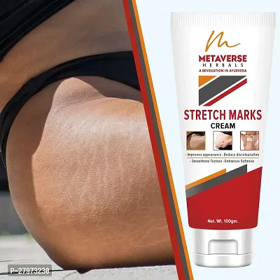 Best stretch mark cream | Pregnancy stretch mark removal | Stretch mark prevention cream | Stretch mark treatment | Natural stretch mark cream.-thumb0