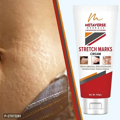 Best stretch mark cream | Pregnancy stretch mark removal | Stretch mark prevention cream | Stretch mark treatment | Natural stretch mark cream.-thumb0