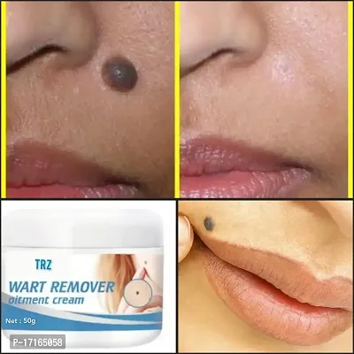 Warts Remover Ointment Wart Treatment Cream For Scar Removal, Anti-acne  Pimples, Marks  Spots Removal-thumb2