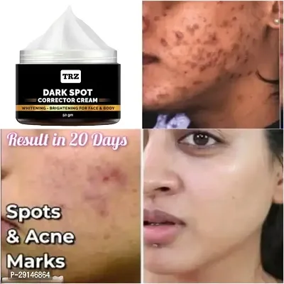 Dark Spot Remover cream, Pimple Marks, Acne Scar, Pigmentation Blemish Removal