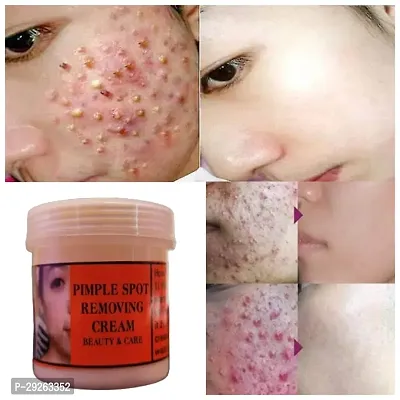 Pimple Cream For Oily Skin,Remove Acne,Dark Spot and Skin MArks.