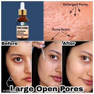 Pore Serum  For Acne Blackheads Open Pores | Reduces Excess Oil  Bumpy Texture