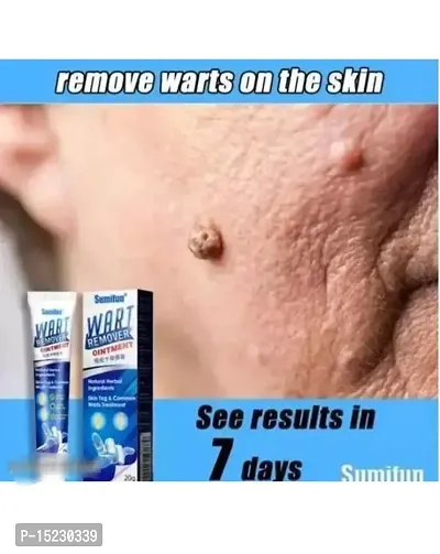Wart Remover Massa Nashak Skin Care