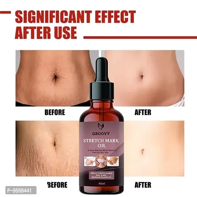 Stretch Marks Oil  Organics Stretch Mark Removal Oil Men Under Arms Stretch Mark Bio Oil And Scars Removal  40 Ml)-thumb0