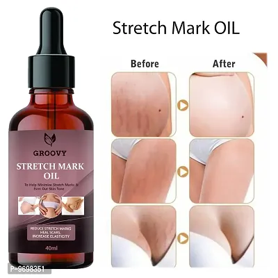 Stretch Marks Oil To Minimize Stretch Marks and Even Out Skin Tone-40Ml  (40 Ml)-thumb0