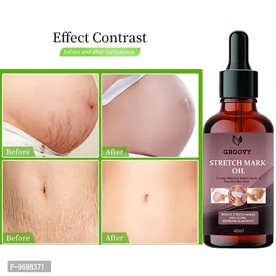 Stretch Marks Oil  Natural Stretch Oil With Coconut,  Olive and Jojoba Oils,  For Scars and Stretchmarks  40 Ml)-thumb0