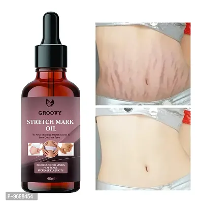 Stretch Marks Oil Unique Repair Stretch Marks Removal, Natural Heal Pregnancy Breast,  Hip,  Legs,  Mark Oil 40 Ml Pack Of 1-thumb0