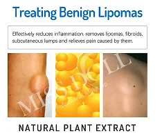 TRS Lipoma Removal Cream, Lipoma Removal Cream Ointment, Lipoma Elimination Cream, for Lipoma Treatment Cellulite Removal Cream, Anti-Swelling Lymphatic Detox Ointment (Pack of 1)-thumb2