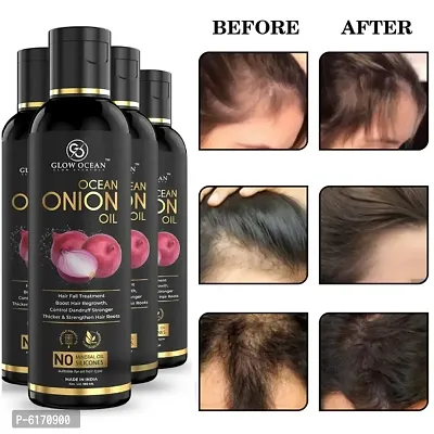 Ocean Onion Oil For Hair Fall Control, Hair Growth and Hair Regrowth-Control Dandruff - Pack Of 4