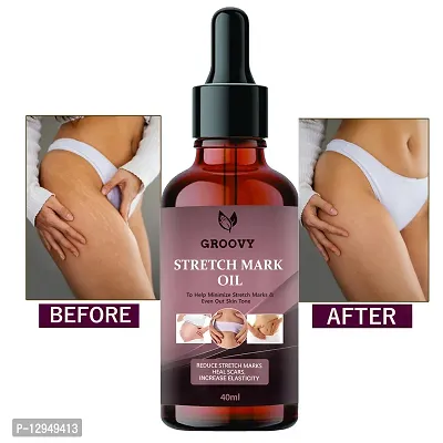 after delivery stretch mark removal OIL 40ml PACK OF 1-thumb0