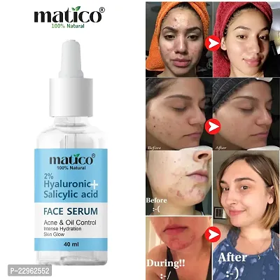 Matico Salicylic + Hyaluronic acid Face Serum for Acne, Pimple Oil Control and Intense Hydration, Skin Glow