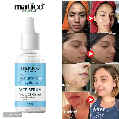 Matico Salicylic + Hyaluronic acid Face Serum for Acne, Pimple Oil Control and Intense Hydration, Skin Glow-thumb0