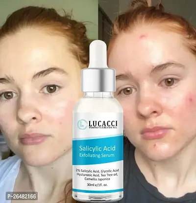 LUCACCI Brightening  Whitening Vitamin C Face Serum, hyaluronic acid for Anti pimple, Acne Free Skin, Aloe Vera extract for face Anti Ageing, Face Oil  Serum for Dry Skin and Oily Skin, Fairness  Face Glow | 30ml *1-thumb0