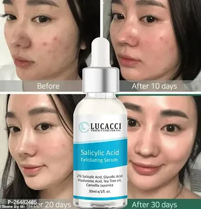 LUCACCI Brightening  Whitening Vitamin C Face Serum, hyaluronic acid for Anti pimple, Acne Free Skin, Aloe Vera extract for face Anti Ageing, Face Oil  Serum for Dry Skin and Oily Skin, Fairness  Face Glow | 30ml *1