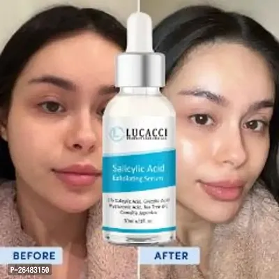 LUCACCI Brightening  Whitening Vitamin C Face Serum, hyaluronic acid for Anti pimple, Acne Free Skin, Aloe Vera extract for face Anti Ageing, Face Oil  Serum for Dry Skin and Oily Skin, Fairness  Face Glow | 30ml *1-thumb0