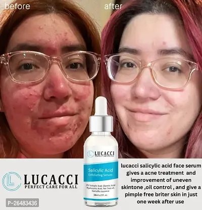 LUCACCI Brightening  Whitening Vitamin C Face Serum, hyaluronic acid for Anti pimple, Acne Free Skin, Aloe Vera extract for face Anti Ageing, Face Oil  Serum for Dry Skin and Oily Skin, Fairness  Face Glow | 30ml *1