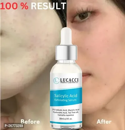 LUCACCI Brightening  Whitening Vitamin C Face Serum, hyaluronic acid for Anti pimple, Acne Free Skin, Aloe Vera extract for face Anti Ageing, Face Oil  Serum for Dry Skin and Oily Skin, Fairness  Face Glow | 30ml *1-thumb0