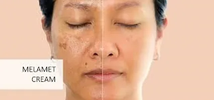 MELAMET SCAR REMOVER  ACNE CARE SKIN CREAM 15 Gm (PACK OF 5) Dark Spot And Pimple Removing Cream.-thumb1