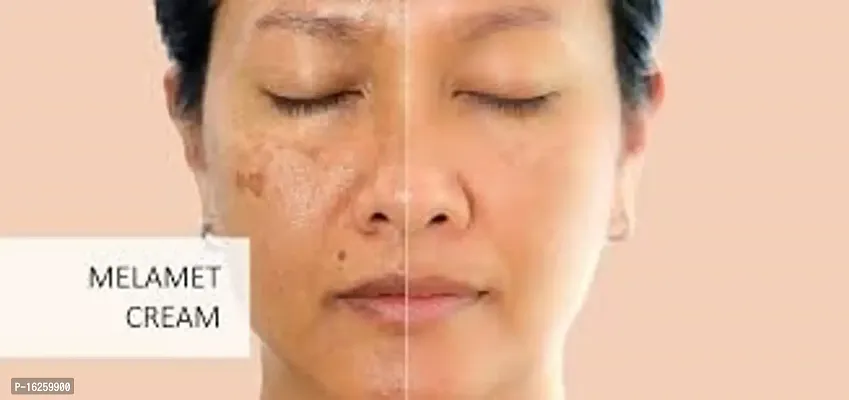 MELAMET SCAR REMOVER  ACNE CARE SKIN CREAM 15 Gm (PACK OF 5) Dark Spot And Pimple Removing Cream.-thumb2
